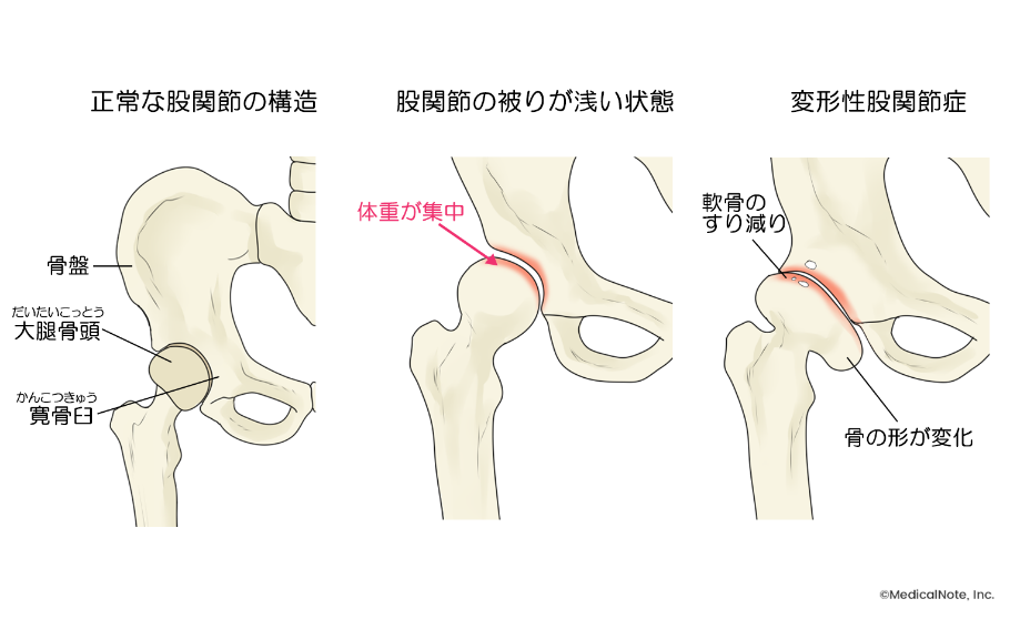 図解：股関節に負担がかかり軟骨のすり減った状態