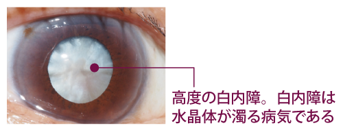 高度の白内障。白内障は水晶体が濁る病気である