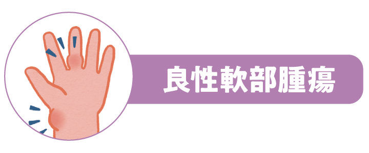 良性軟部腫瘍