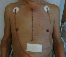 Median sternotomy