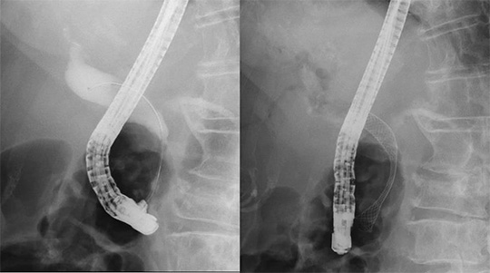 悪性腫瘍の場合の対処方法の写真