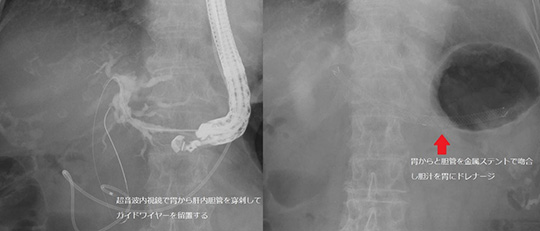 悪性腫瘍で通常のERCPが出来ない場合の対処方法の写真