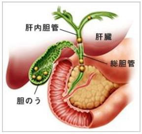 胆石の分類の画像