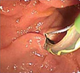 EST（内視鏡的乳頭括約筋切開術endscopic sphincterotomy）の写真