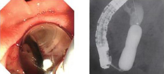 EPBD（内視鏡的乳頭バルーン拡張術endscopic papillary balloon dilateon）の写真