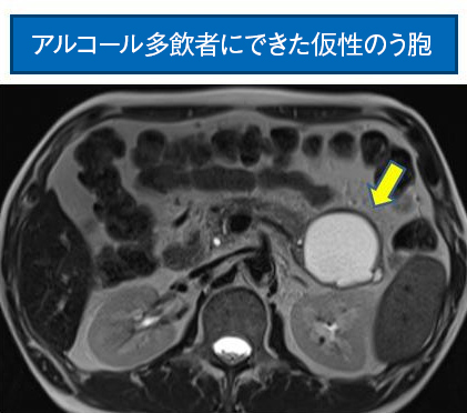 アルコール多飲者にできた仮性のう胞の画像