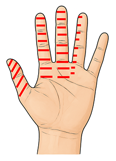 親指から薬指のしびれる範囲を示した画像