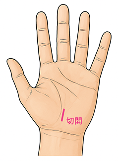 手のひら手首側の切開部位を示した画像