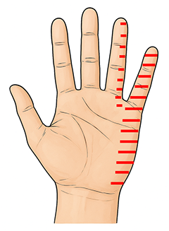 小指・薬指のしびれる範囲を示した画像