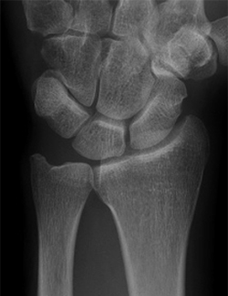 正常な手関節X線像正面の画像
