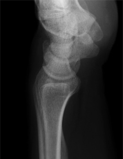 正常な手関節X線像側面の画像