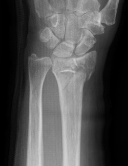 橈骨遠位端骨折のX線像正面の画像