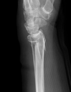 橈骨遠位端骨折のX線像側面の画像
