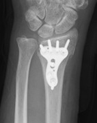 プレートで固定したX線画像