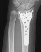 プレートで固定したX線画像