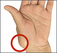 母指CM関節の画像