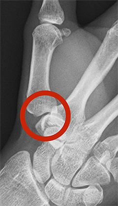 正常な母指CM関節を示したX線画像