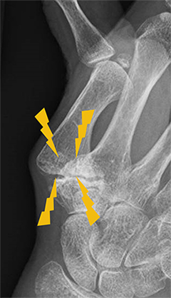 軟骨が減り、変形している母指CM関節を示したX線画像