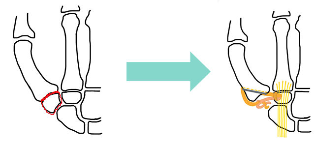 関節形成術の画像