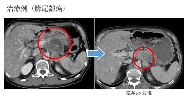 治療例(膵尾部癌)