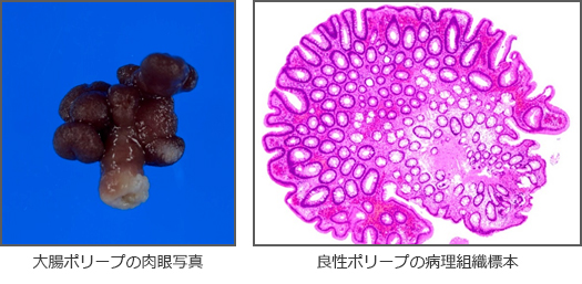 大腸ポリープの肉眼写真　良性ポリープの病理組織標本