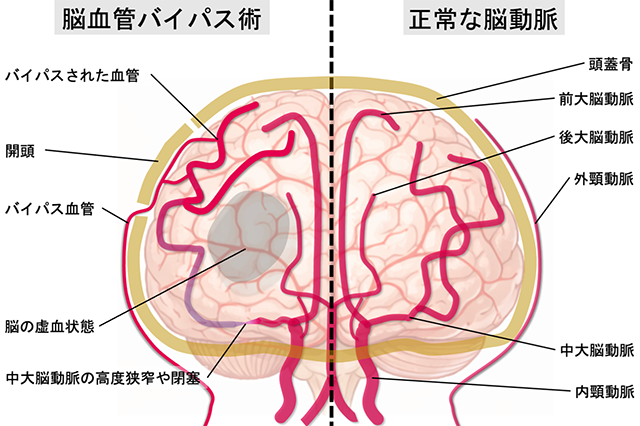 脳血管バイパス術と正常な脳動脈の画像