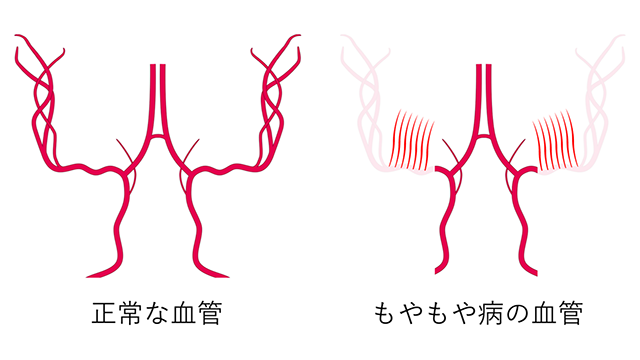 正常な血管ともやもや病の血管の画像