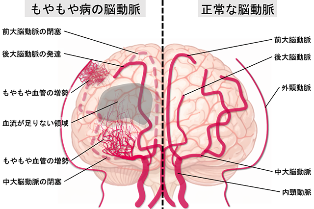 もやもや病の脳動脈と正常な脳動脈の画像