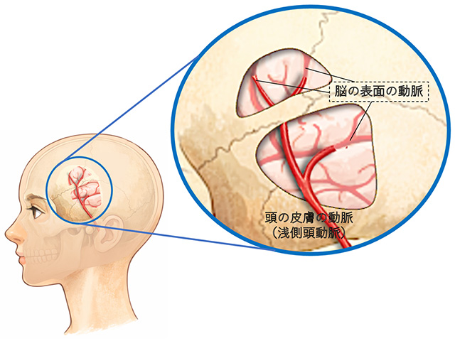 バイパス手術の一例を模式化した画像