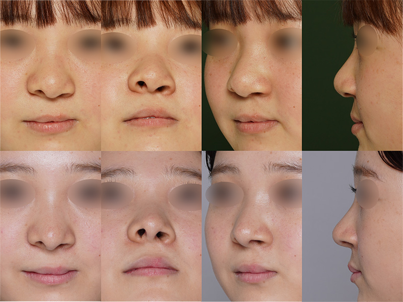 上段：術前　下段：術後6ヶ月の症例写真