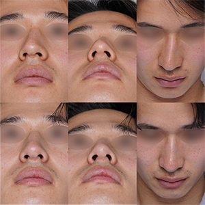 術前と術後の写真