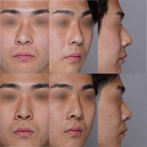 術前と術後の写真