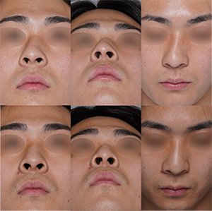 術前と術後の写真