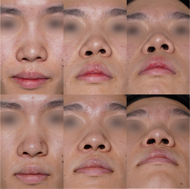 症例 術前と術後6ヶ月の写真