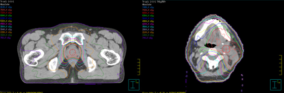 強度変調放射線治療のX線画像
