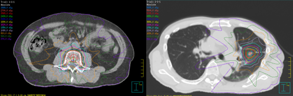 定位放射線治療のX線画像