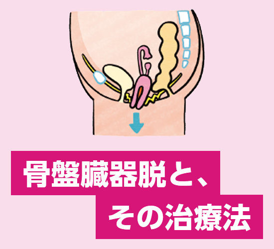 骨盤臓器脱イメージイラスト