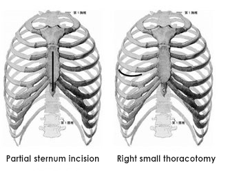 Minimally invasive cardiac surgery (MICS) conducted with a small incision