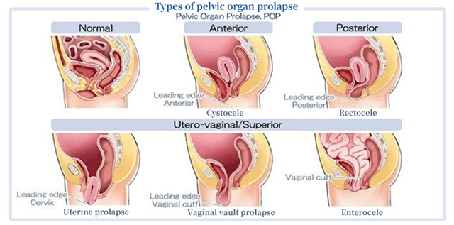 Image of types of pelvic organ prolapse