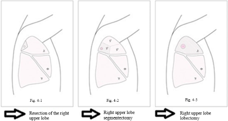 Fig.2 Surgical procedures for partial resection, segmentectomy, and lobectomy